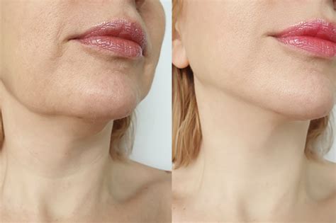 The Amazing Results of Lymphatic Drainage Face Before and After - Ramon Landia