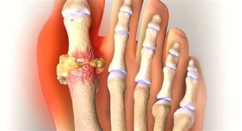 Skeletal Tuberculosis