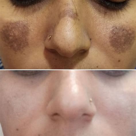 Pigmentation Treatment - Dr. Nishita Ranka