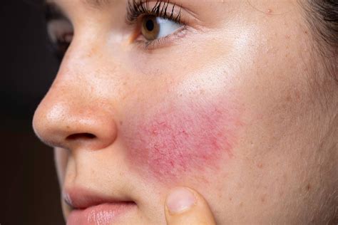 Find The Best Rosacea Treatment Plans Here!