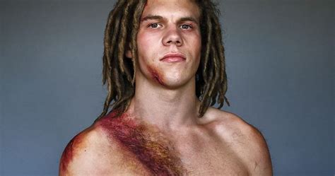 10 Car Crash Survivors Pose Proudly For A Chilling Photo Project To ...