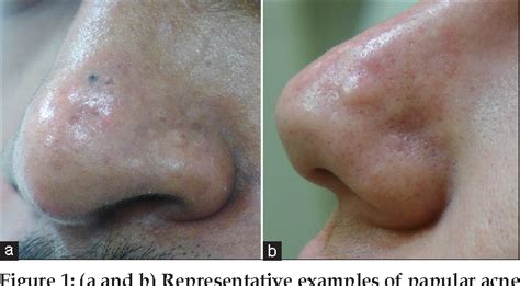 Papular Acne Scars of the Nose and Chin: An Under-recognised Variant of ...