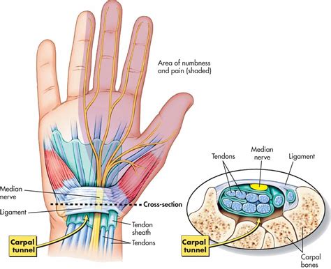 Carpal Tunnel Syndrome