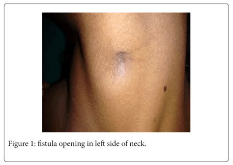 Thyroglossal Cyst And Fistula Surgical Pitfalls And Causes Of | Images ...