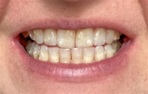 14 Week Invisalign Results 28 Week Invisalign Results