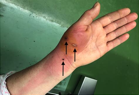 Cureus | Rapidly Progressive Infection of Hand After a Cat Bite