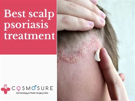 Best Scalp Psoriasis Treatment | Cosmosure Clinic