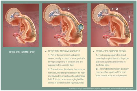 Ann Strickland Viral: Fetal Spina Bifida Surgery