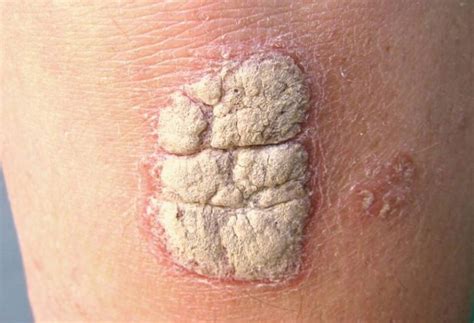 Risankizumab vs Secukinumab in Patients With Plaque Psoriasis - Dermatology Advisor