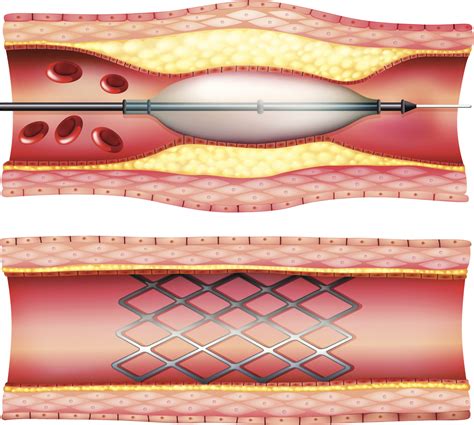 Interventional Cardiology: A Look Back at 4 Decades of Practice ...