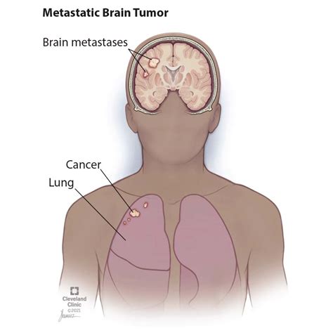 Most Common Primary Brain Tumor