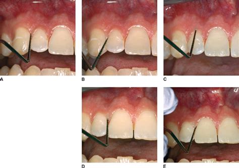 Periodontal measurements: indicators of disease and conditions | Pocket Dentistry