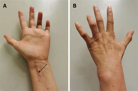 Ulnar Nerve Entrapment Wrist