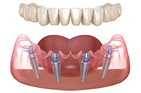 What are All-on-4 Dental Implants? - South Gables Dental