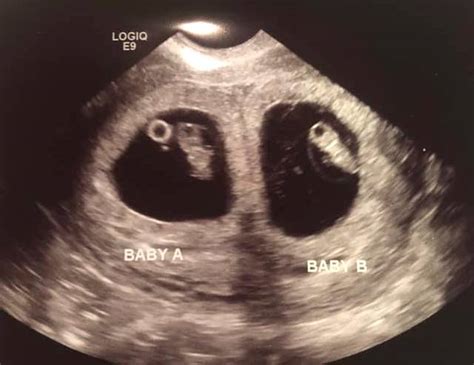 7 Week Ultrasound Identical Twins