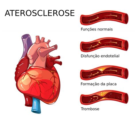 Aterosclerose - causas, sintomas, tratamentos - InfoEscola