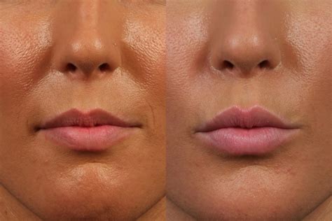 Avoid Lip Filler Mistakes | Dr. Brett Kotlus, Cosmetic Oculoplastic ...