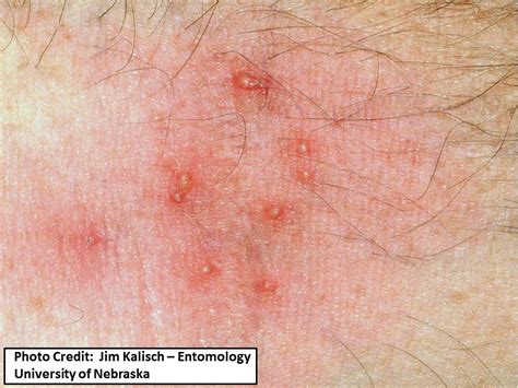 Dermatitis Mites
