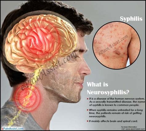 what-neurosyphilis | HealthGist.Net