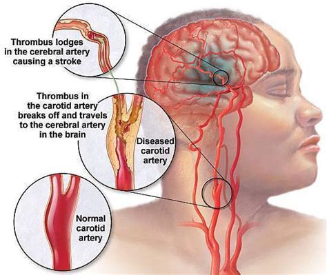 Symptoms of Blocked Carotid Artery – Medical Symptoms Guide