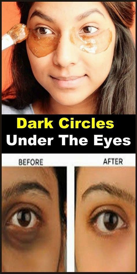 Home Remedies To Get Rid Of Dark Circles Under The Eyes | Dark eye circles, Dark circle remedies ...