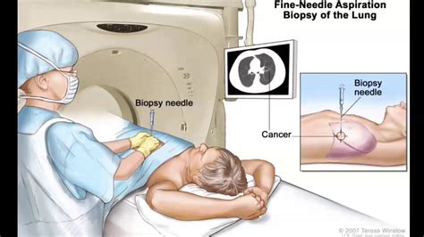 Biopsy Treatment Video | Mediastinal Biopsy | CT Guided Lung Biopsy - YouTube