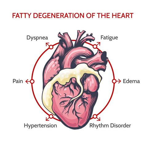 Fatty Degeneration of the Heart. Symptoms of Decease Illustration Stock Vector - Illustration of ...