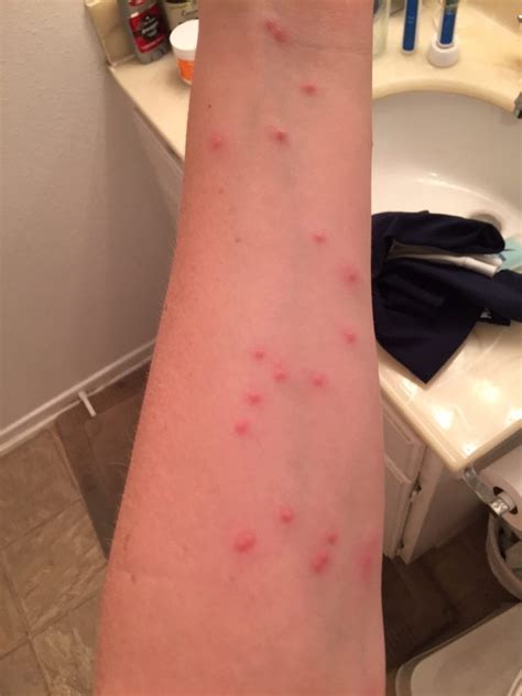 Bed Bug Bites vs. Flea Bites - Bed Bug Cleveland, Ohio | Bed Bug Exterminators