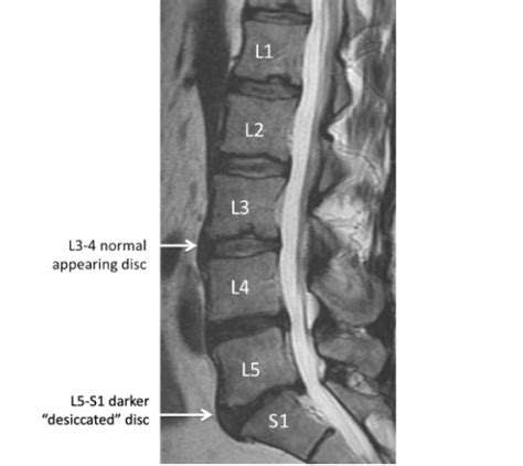 Understanding Your MRI of the Lumbar Spine