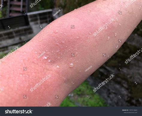 홍발진과 팔피부의 가려운 증상이 있는 급성 스톡 사진 1707313663 | Shutterstock