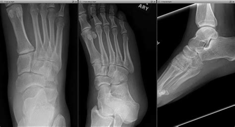 Surgical Management Navicular and Cuboid Fractures - Clinics in ...