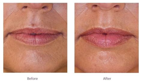 Lip Filler Before and After | Lip Fillers London, Buckinghamshire | The ...