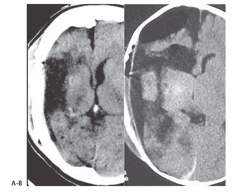 Functional Hemispherectomy and Periinsular Hemispherectomy | Neupsy Key