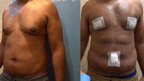 Gynecomastia Surgery: 48 hrs Post Op on Wisconsin MALE - YouTube