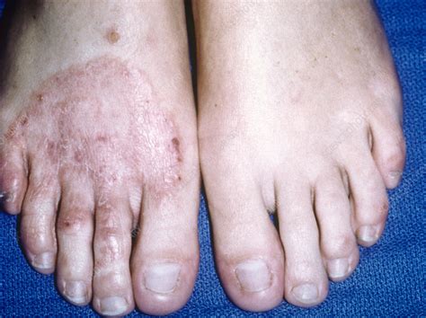 Ringworm Fungal Infection