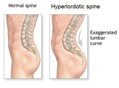 Hyperlordosis | 70's Big