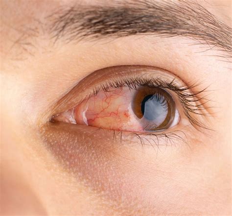 Allergic pink eye | Learn more about symptoms and treatment here - us ...