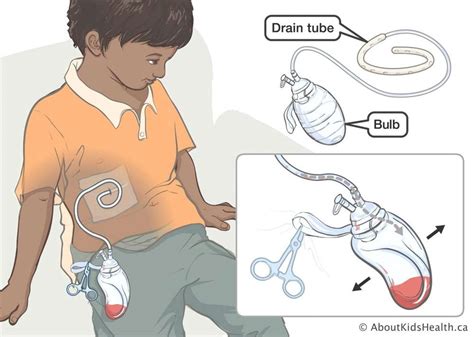 Does JP Drain Removal Hurt? If You Are Careful, It Does Not