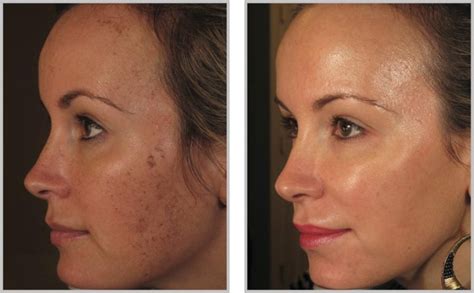 BBL Facial Rejuvenation Treatment - Coyle Institute