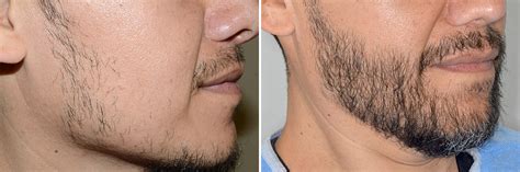 Beard Transplant Photos | Miami, FL | Patient 6392