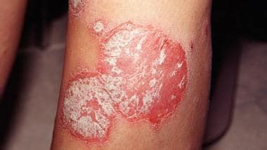 Symptoms Of Plaque Psoriasis