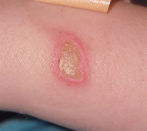 Removing Slough? : r/woundcare