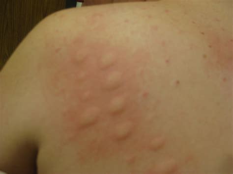 I get skin rashes whenever I'm sick. Should I be worried? : r/AskDocs