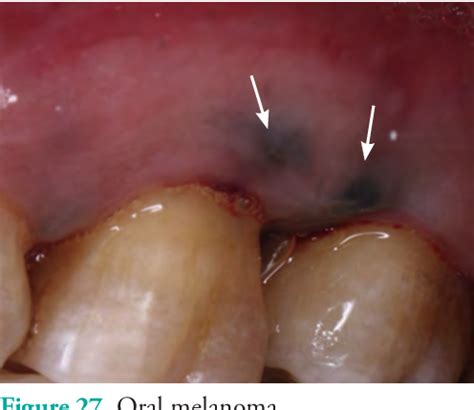 Figure 27 from Overview of common oral lesions | Semantic Scholar