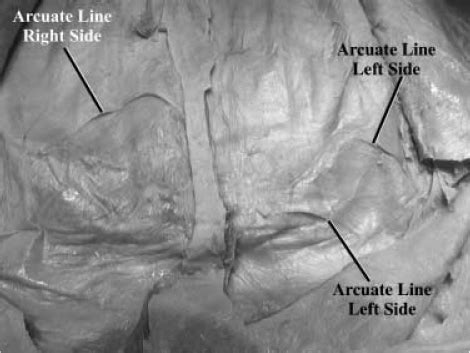 Type II arcuate line (right side) in which the fibers of the posterior ...