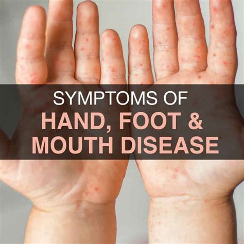 Can Hand Foot And Mouth Cause Sores On Face Store | emergencydentistry.com