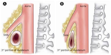 Superior Mesenteric Artery syndrome, an extremely rare vascular/GI condition | Superior ...