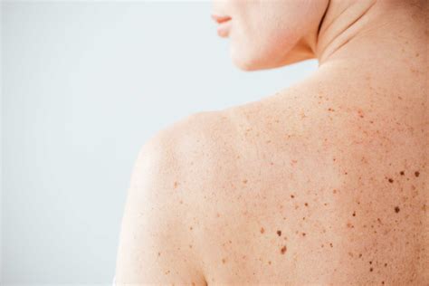 Things To Know About Hyperpigmentation: Types, Causes & Treatment