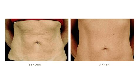 Thermage Body Before and Afters | Infinity Skin Clinic Sydney