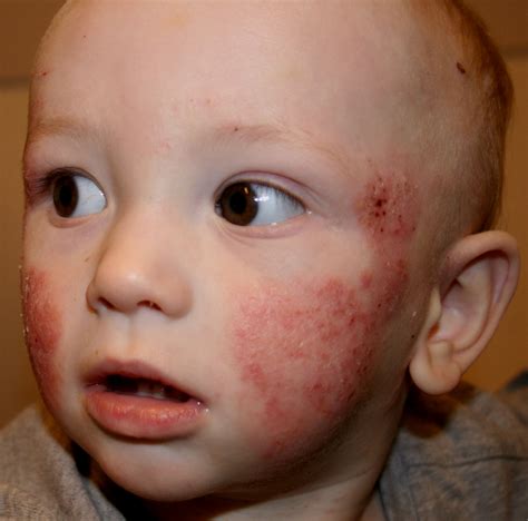 Medical Pictures Info – Atopic Dermatitis